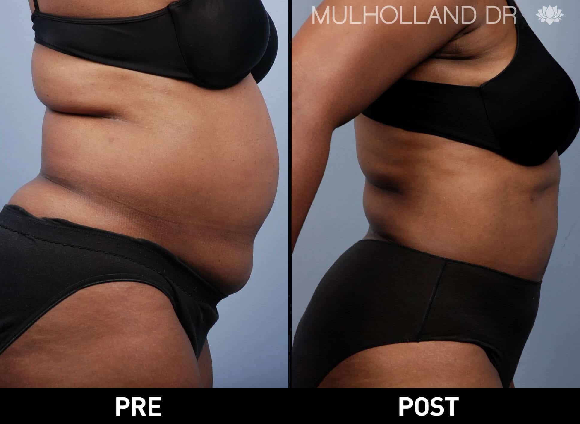 BodyTite Liposuction - Before and After Gallery - Patient Photo 19