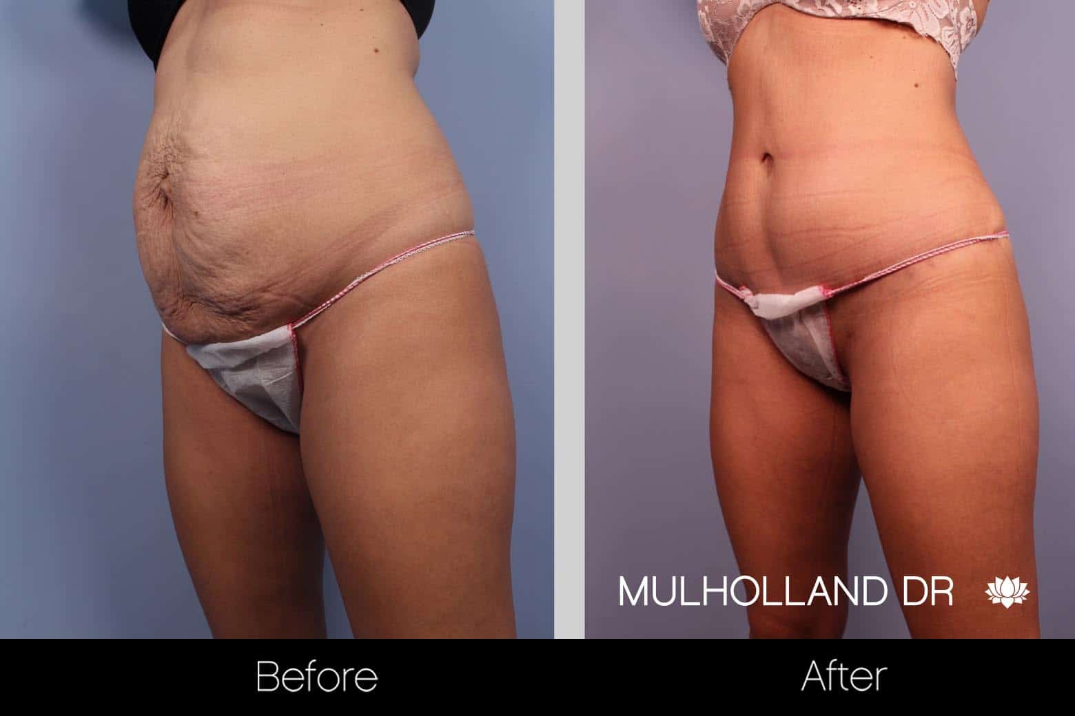 BodyTite Liposuction - Before and After Gallery - Patient Photo 2
