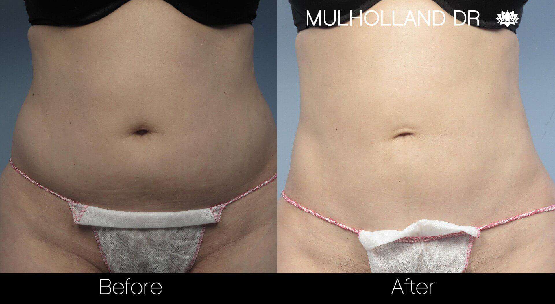 BodyTite Liposuction - Before and After Gallery - Patient Photo 20
