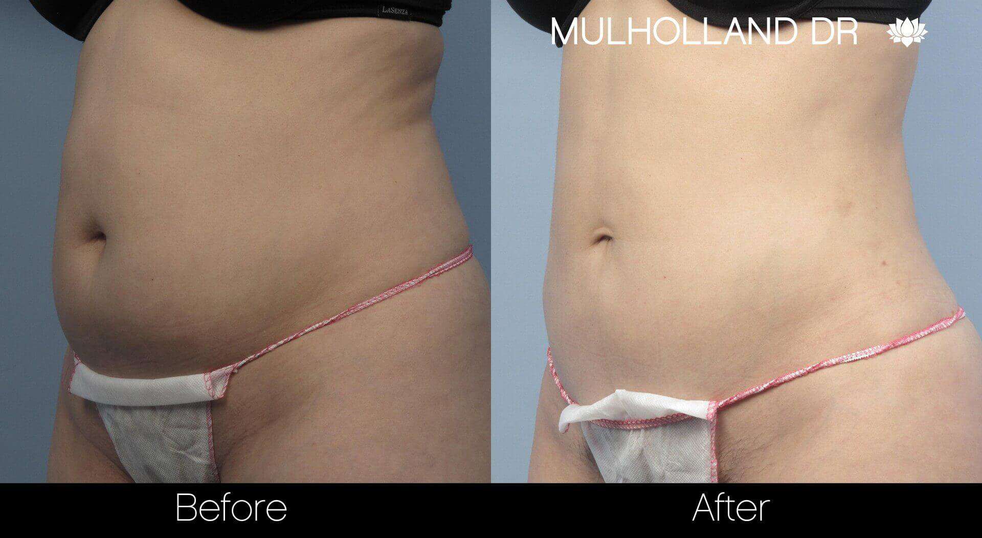 BodyTite Liposuction - Before and After Gallery - Patient Photo 21
