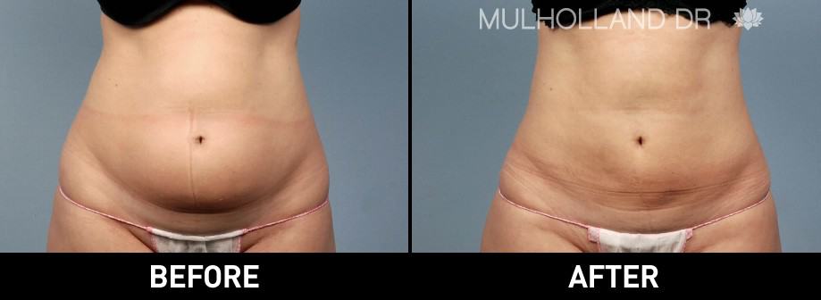 BodyTite Liposuction - Before and After Gallery - Patient Photo 22