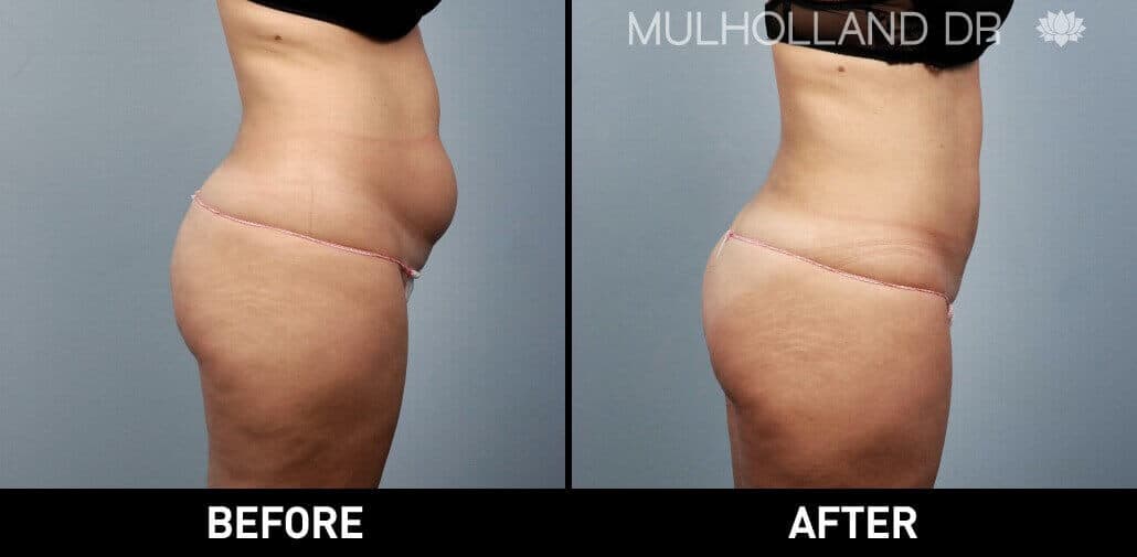 BodyTite Liposuction - Before and After Gallery - Patient Photo 23