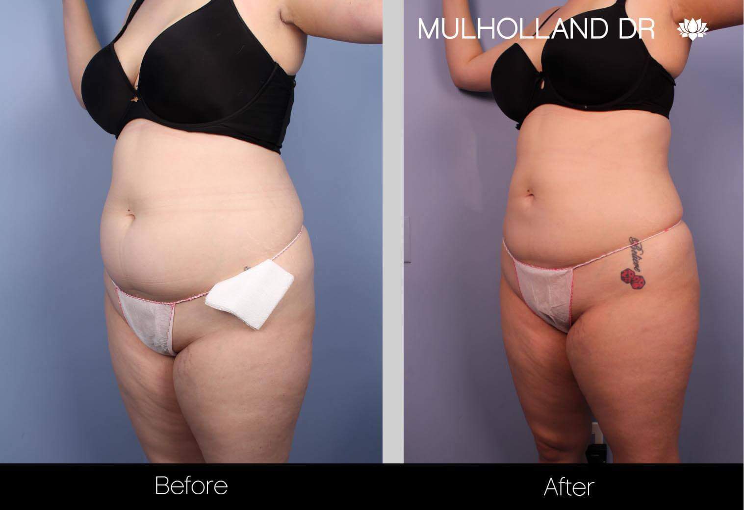 BodyTite Liposuction - Before and After Gallery - Patient Photo 26
