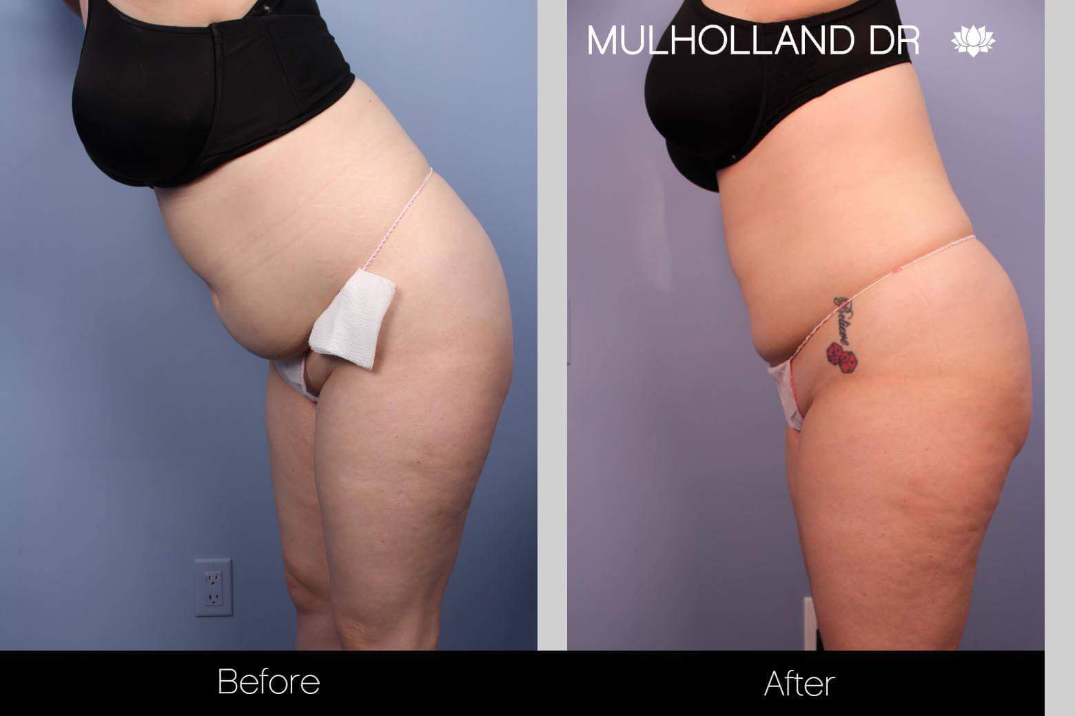 BodyTite Liposuction - Before and After Gallery - Patient Photo 27