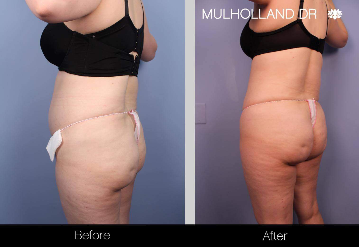 BodyTite Liposuction - Before and After Gallery - Patient Photo 28
