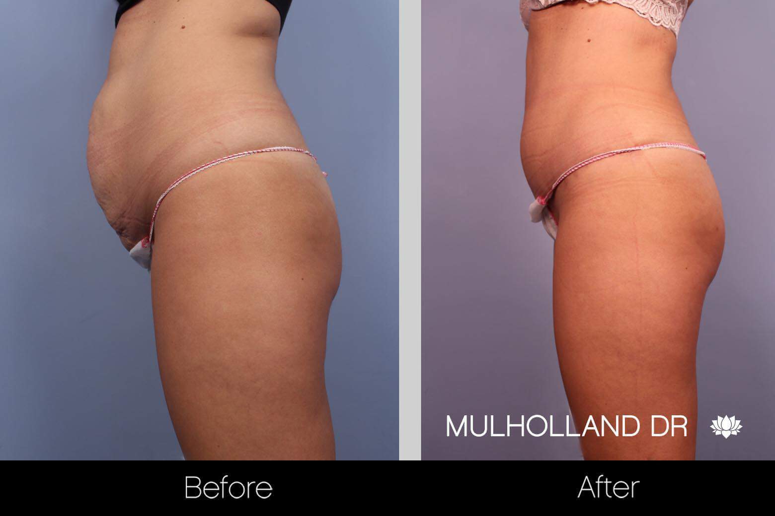 BodyTite Liposuction - Before and After Gallery - Patient Photo 3