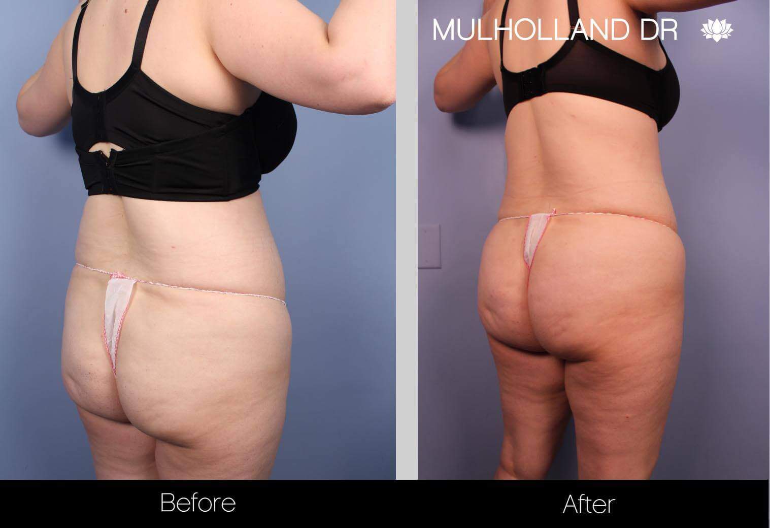 BodyTite Liposuction - Before and After Gallery - Patient Photo 30