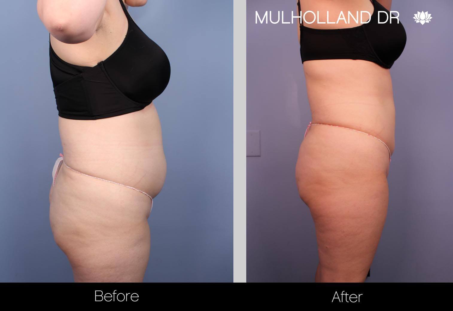BodyTite Liposuction - Before and After Gallery - Patient Photo 31