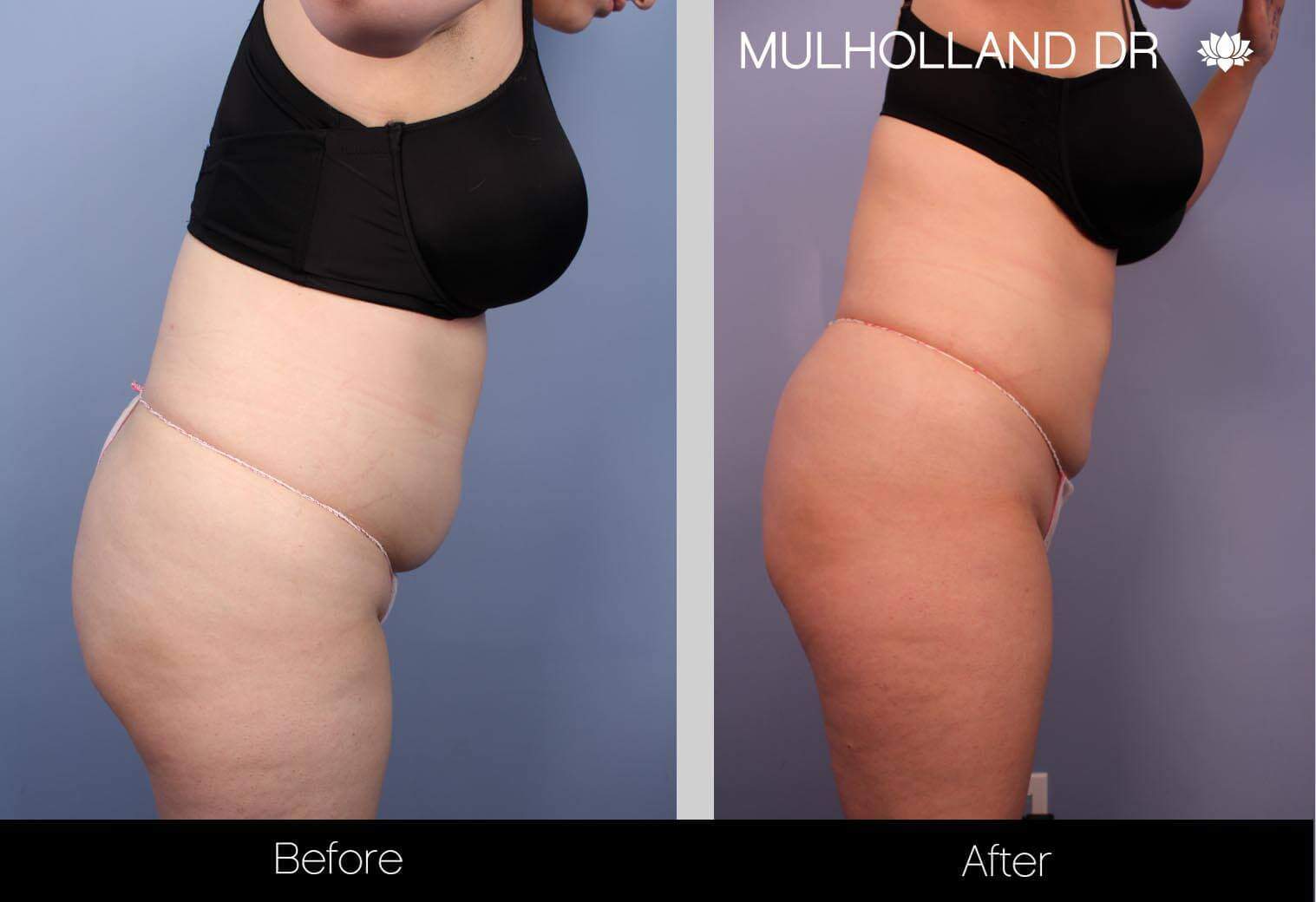 BodyTite Liposuction - Before and After Gallery - Patient Photo 32