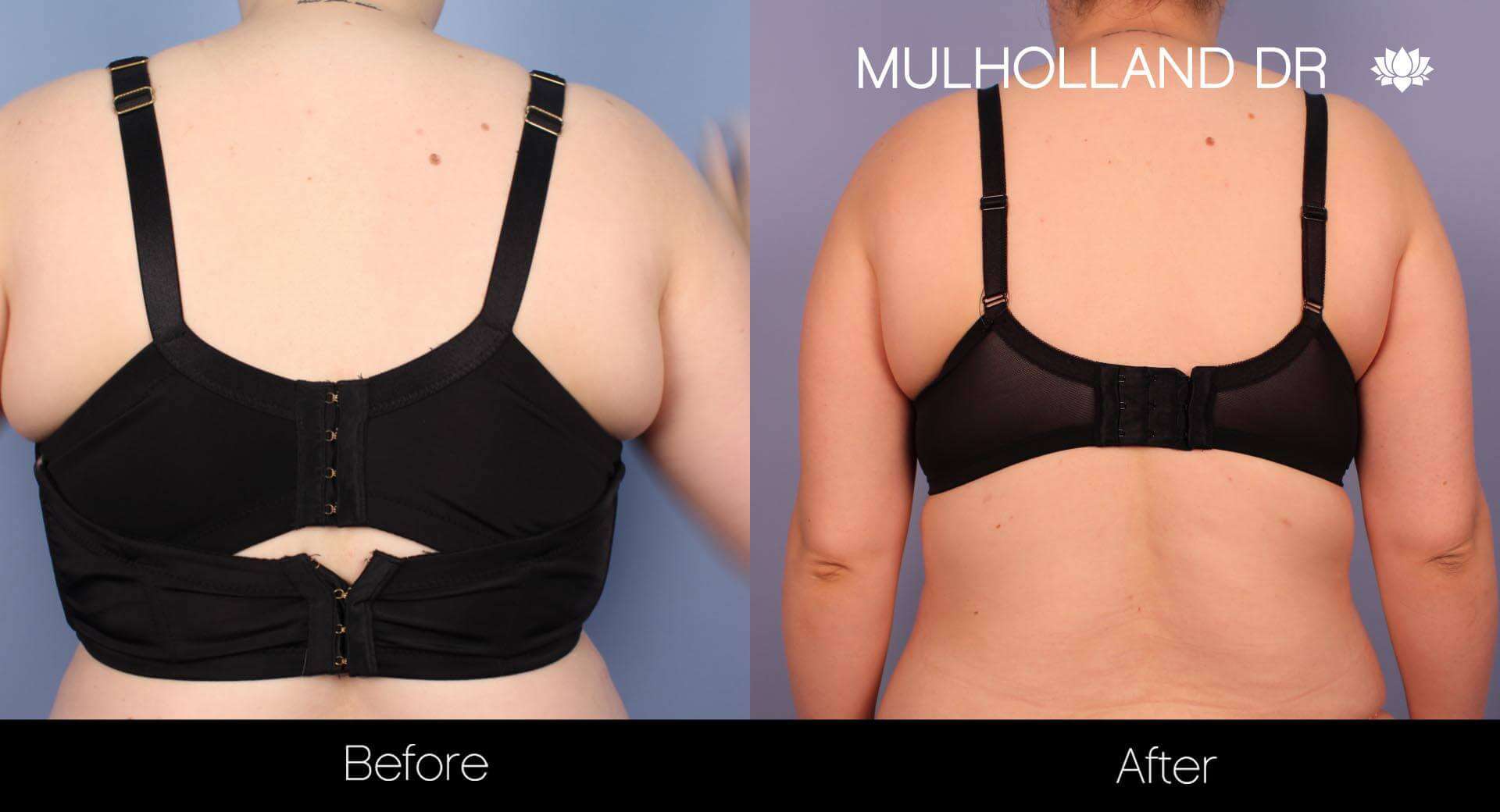 BodyTite Liposuction - Before and After Gallery - Patient Photo 33
