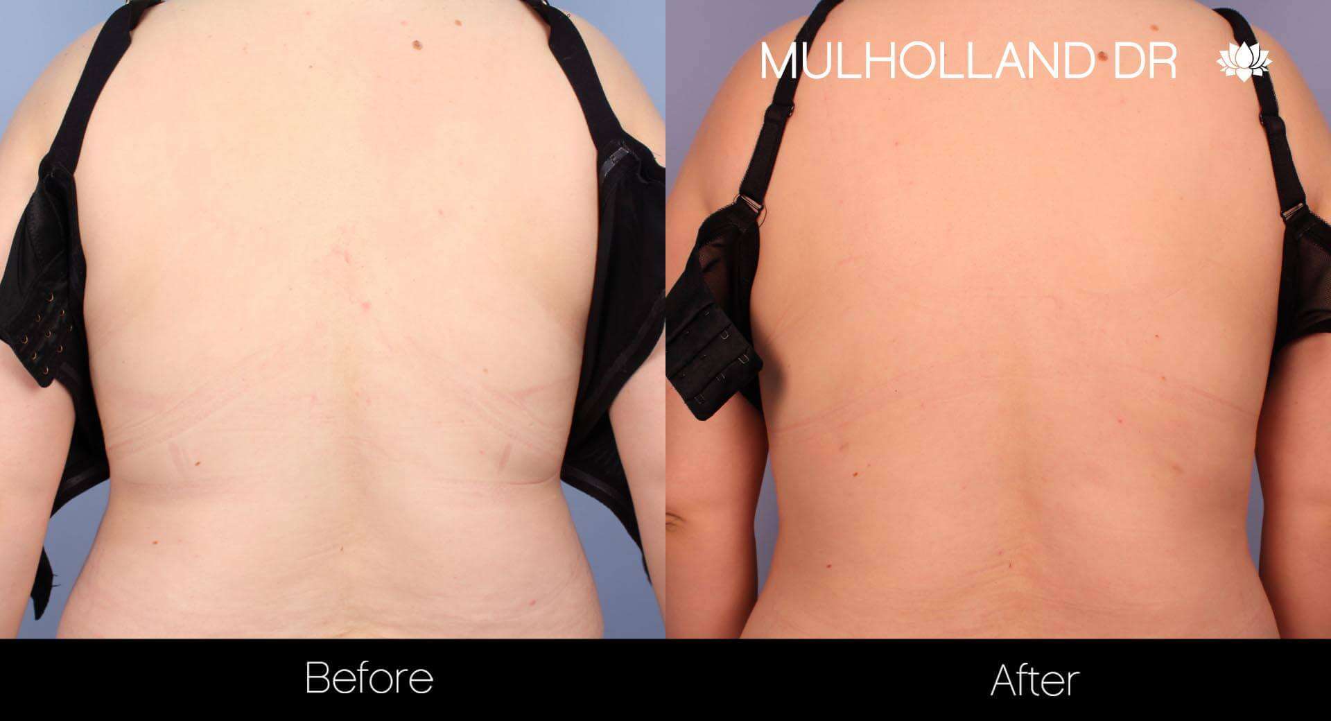 BodyTite Liposuction - Before and After Gallery - Patient Photo 34