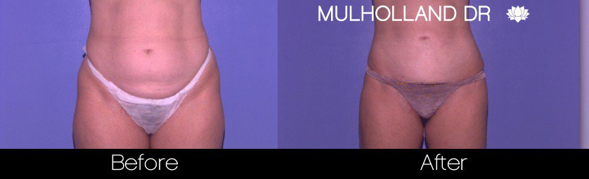 BodyTite Liposuction - Before and After Gallery - Patient Photo 35