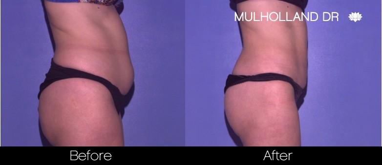 BodyTite Liposuction - Before and After Gallery - Patient Photo 37