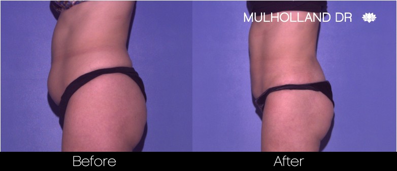 BodyTite Liposuction - Before and After Gallery - Patient Photo 38