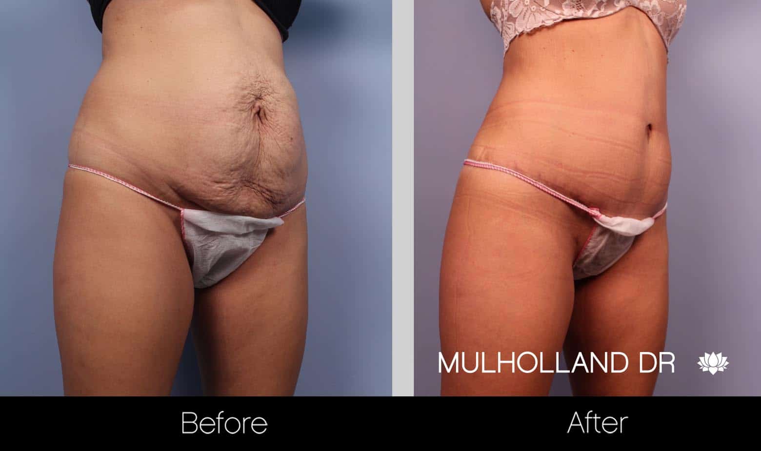 BodyTite Liposuction - Before and After Gallery - Patient Photo 3
