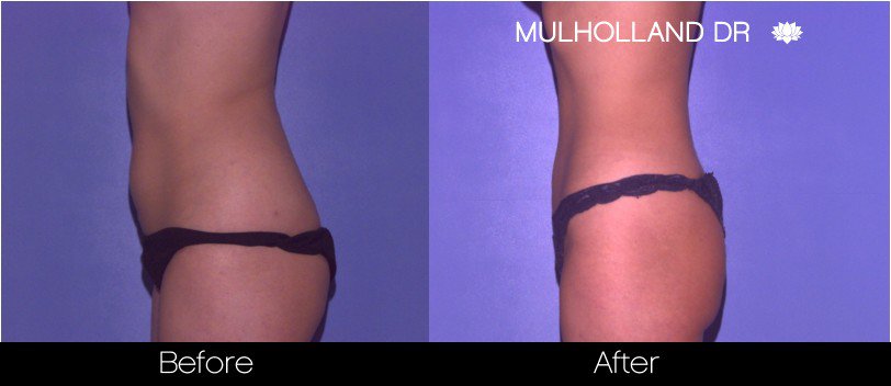 BodyTite Liposuction - Before and After Gallery - Patient Photo 40