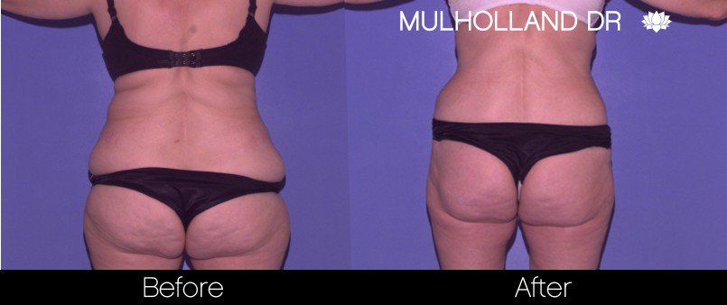 BodyTite Liposuction - Before and After Gallery - Patient Photo 46