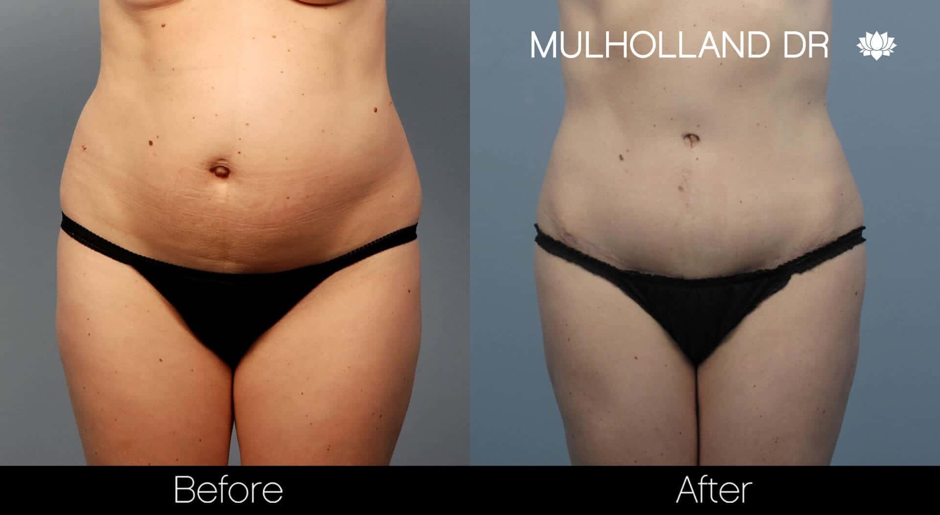 BodyTite Liposuction - Before and After Gallery - Patient Photo 56