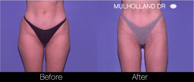 BodyTite Liposuction - Before and After Gallery - Patient Photo 57