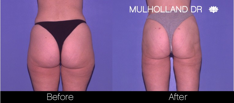 BodyTite Liposuction - Before and After Gallery - Patient Photo 58