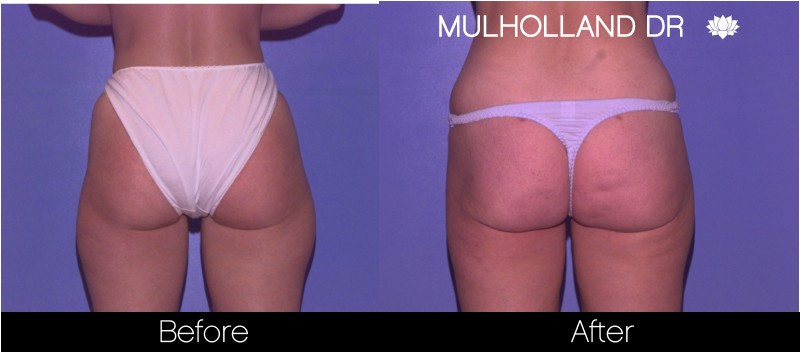 BodyTite Liposuction - Before and After Gallery - Patient Photo 59