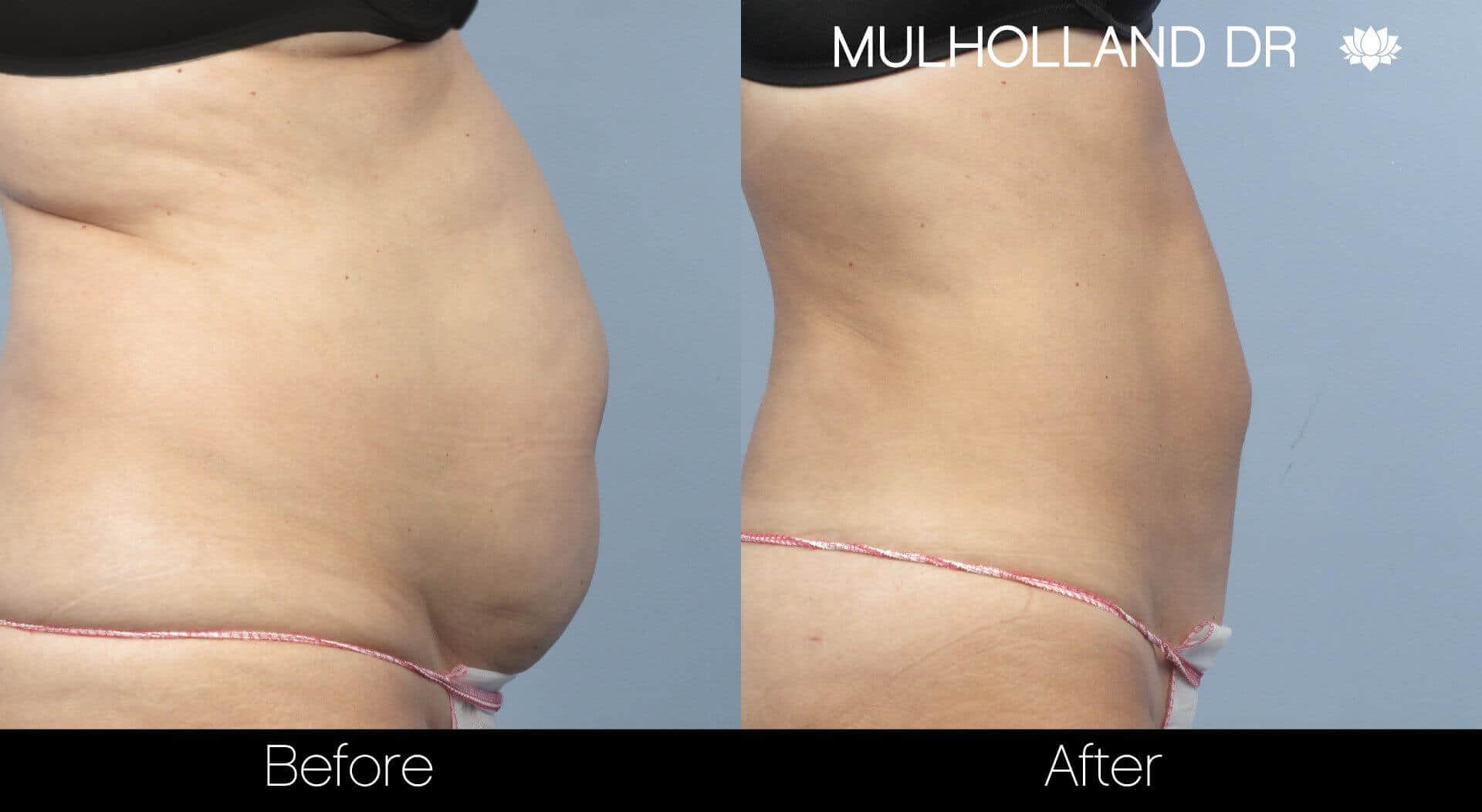 BodyTite Liposuction - Before and After Gallery - Patient Photo 6
