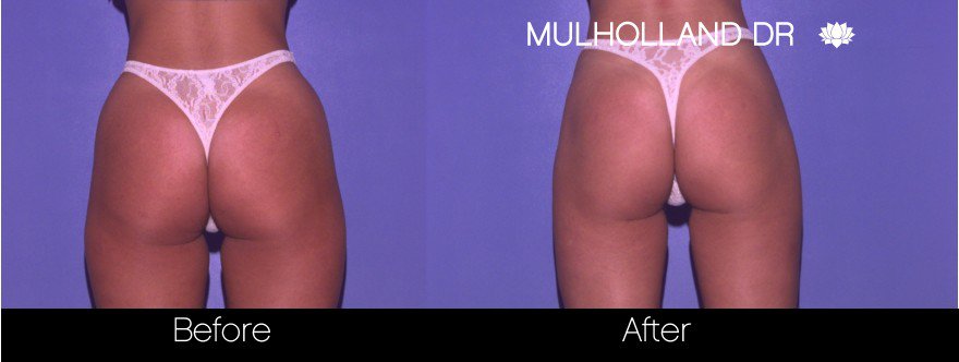 BodyTite Liposuction - Before and After Gallery - Patient Photo 60