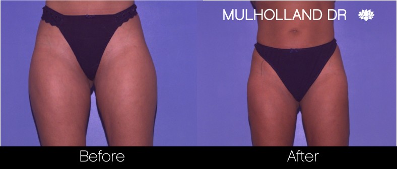 BodyTite Liposuction - Before and After Gallery - Patient Photo 62