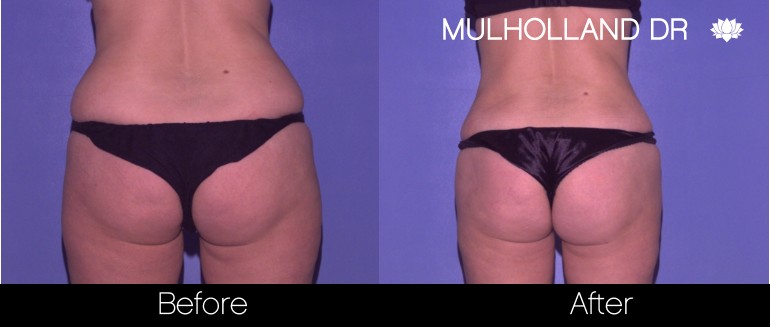 BodyTite Liposuction - Before and After Gallery - Patient Photo 63
