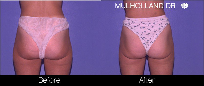 BodyTite Liposuction - Before and After Gallery - Patient Photo 64