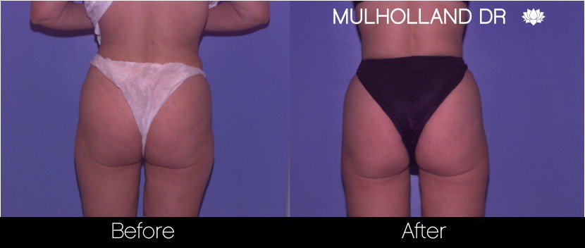 BodyTite Liposuction - Before and After Gallery - Patient Photo 65