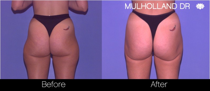 BodyTite Liposuction - Before and After Gallery - Patient Photo 66
