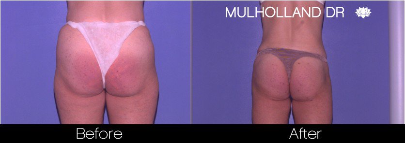 BodyTite Liposuction - Before and After Gallery - Patient Photo 67