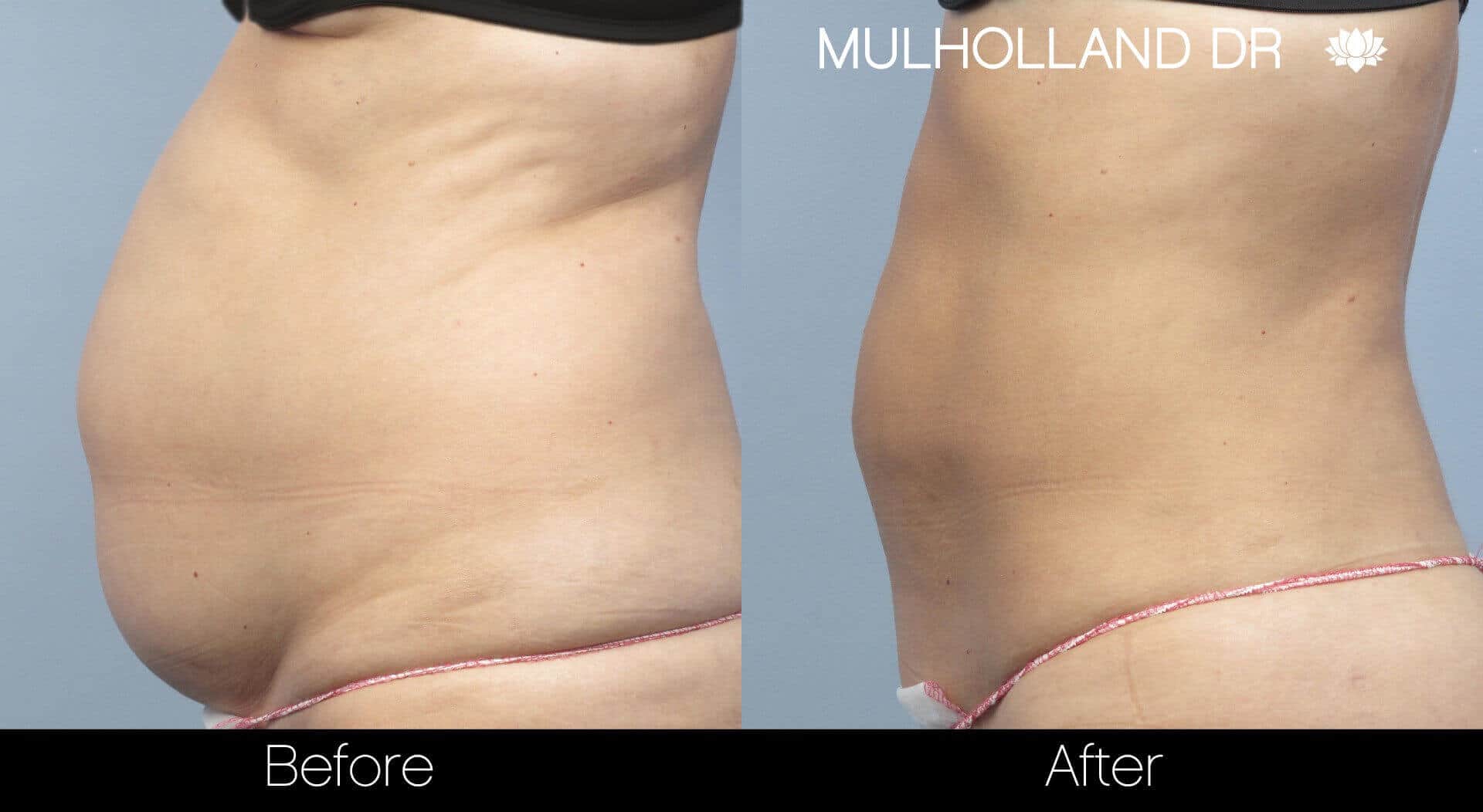 BodyTite Liposuction - Before and After Gallery - Patient Photo 7