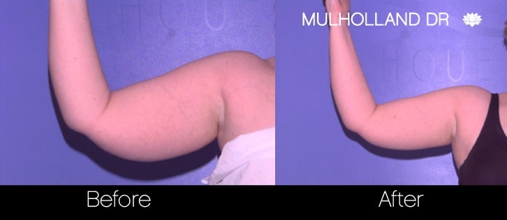 BodyTite Liposuction - Before and After Gallery - Patient Photo 72
