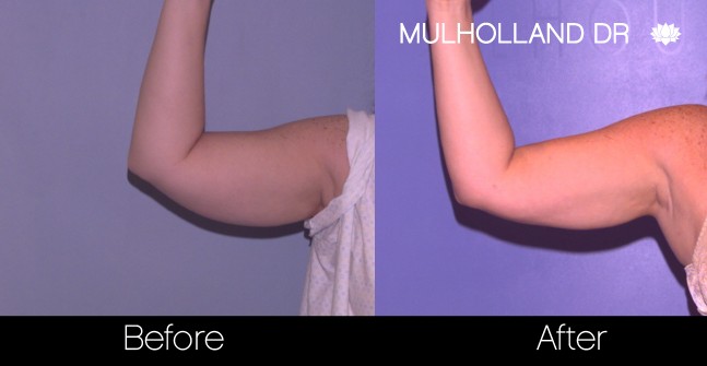 BodyTite Liposuction - Before and After Gallery - Patient Photo 74