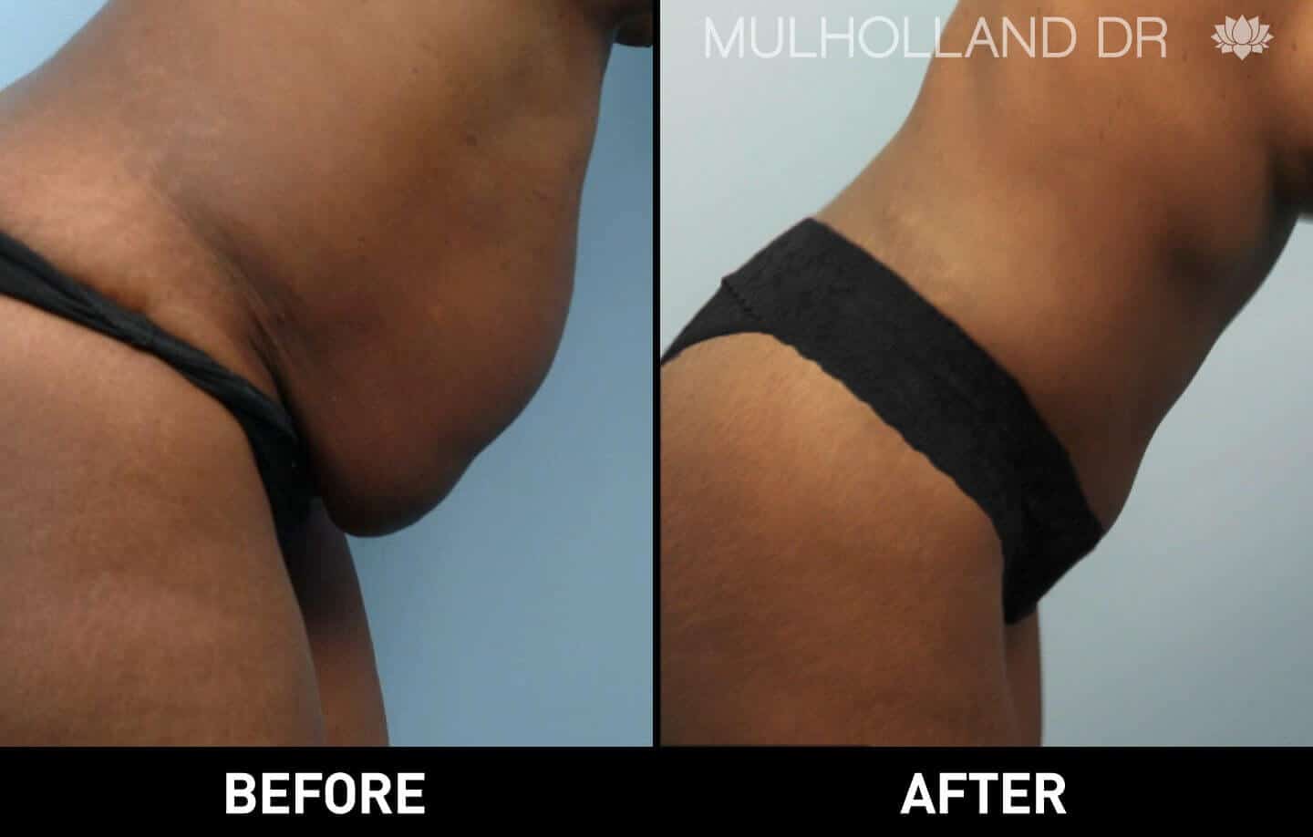 BodyTite Liposuction - Before and After Gallery - Patient Photo 8