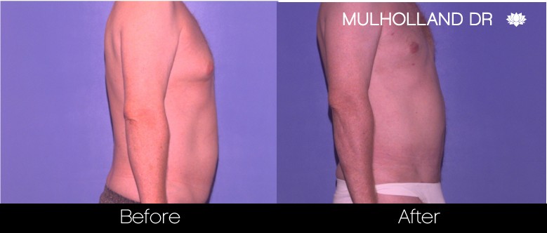 BodyTite Liposuction - Before and After Gallery - Patient Photo 83
