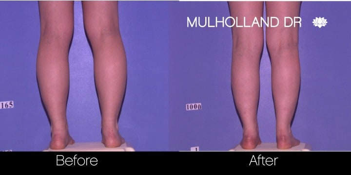 BodyTite Liposuction - Before and After Gallery - Patient Photo 90