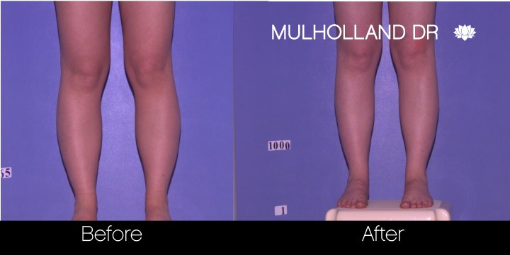 BodyTite Liposuction - Before and After Gallery - Patient Photo 91
