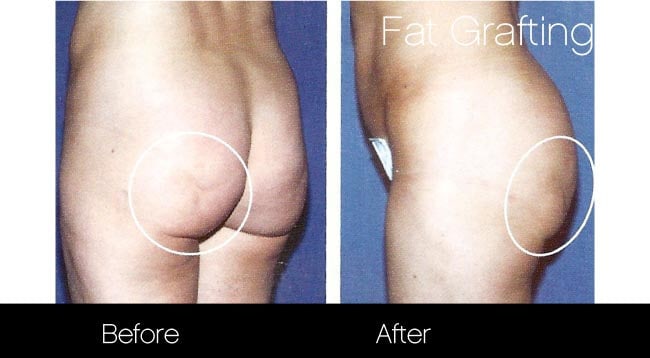 Brazilian Butt Lift -Before and After Gallery - Patient Photo 17