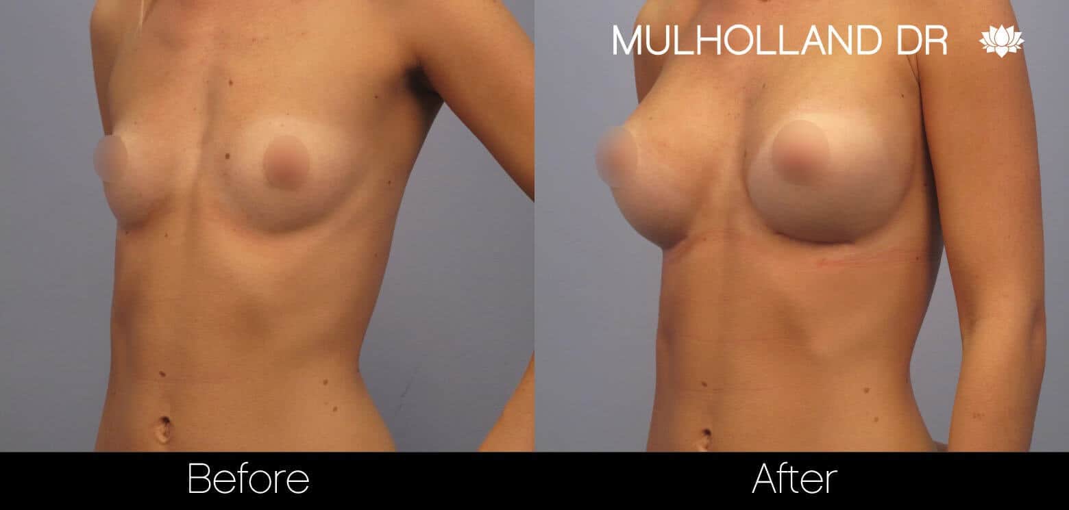 Breast Augmentation - Before and After Gallery - Patient Photo 10