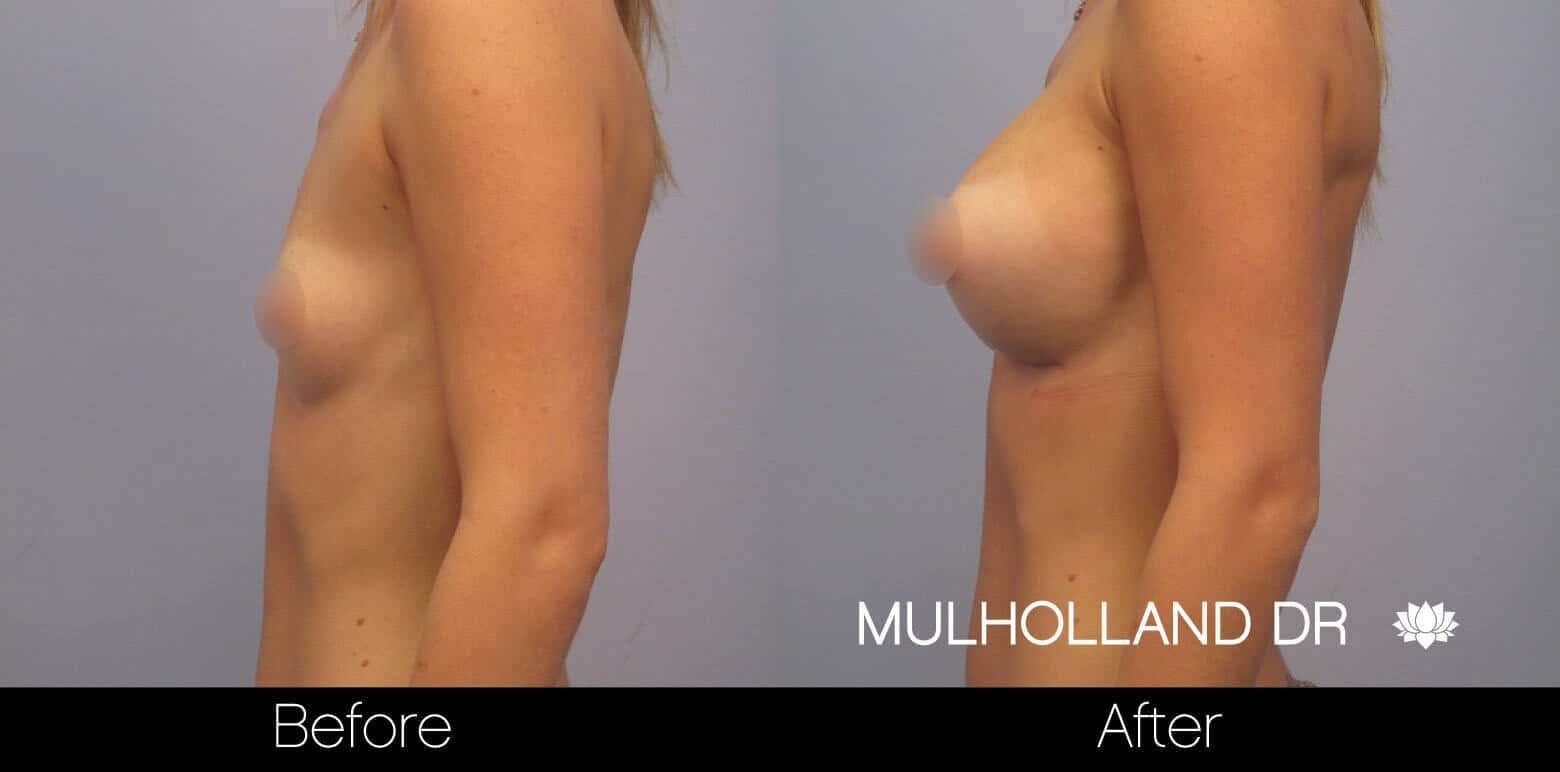 Breast Augmentation - Before and After Gallery - Patient Photo 11