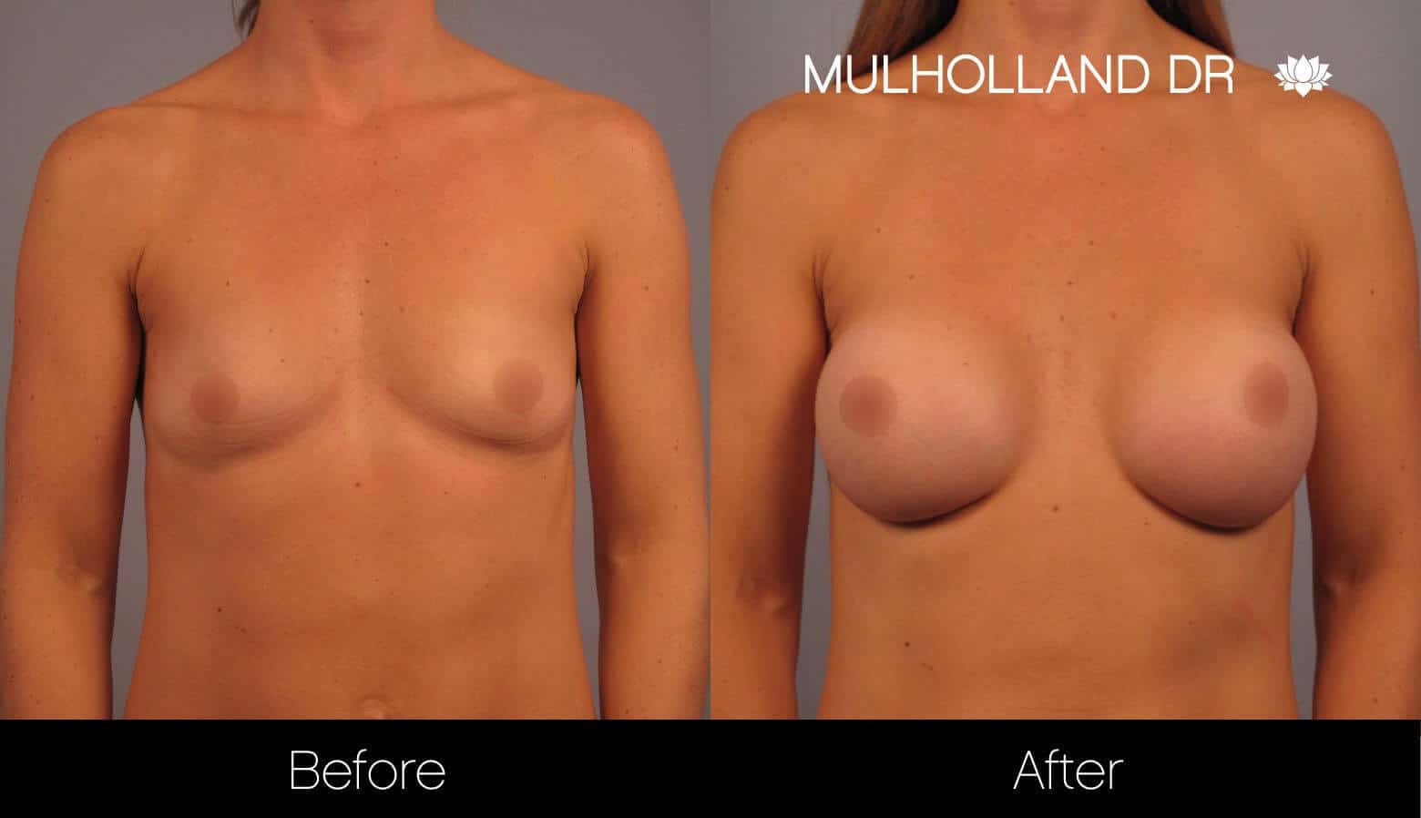 Breast Augmentation - Before and After Gallery - Patient Photo 12