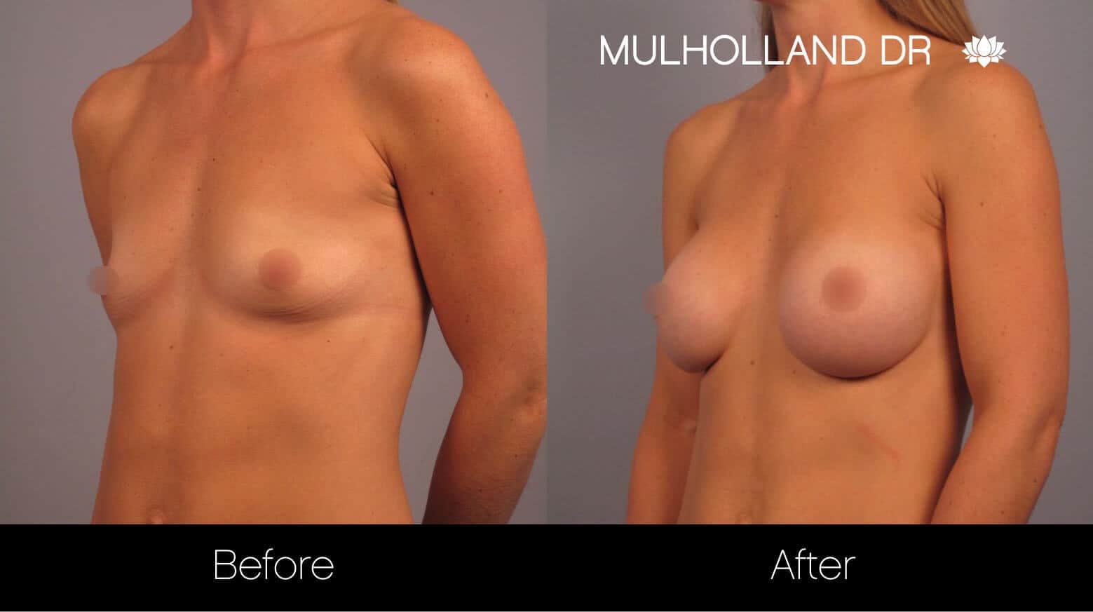 Breast Augmentation - Before and After Gallery - Patient Photo 13