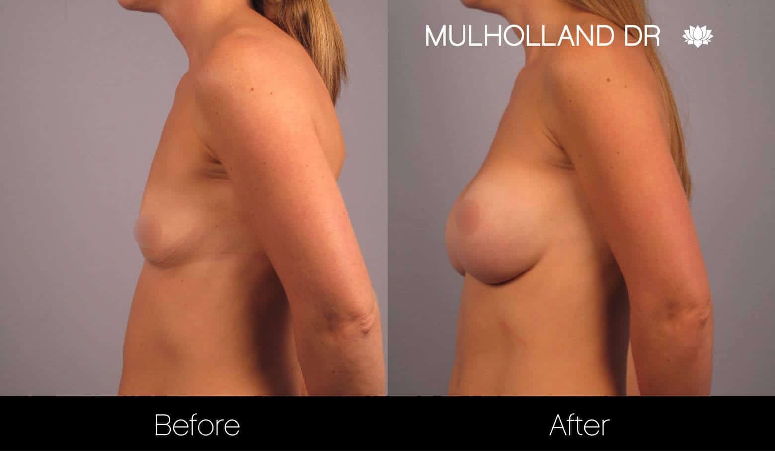Breast Augmentation - Before and After Gallery - Patient Photo 14