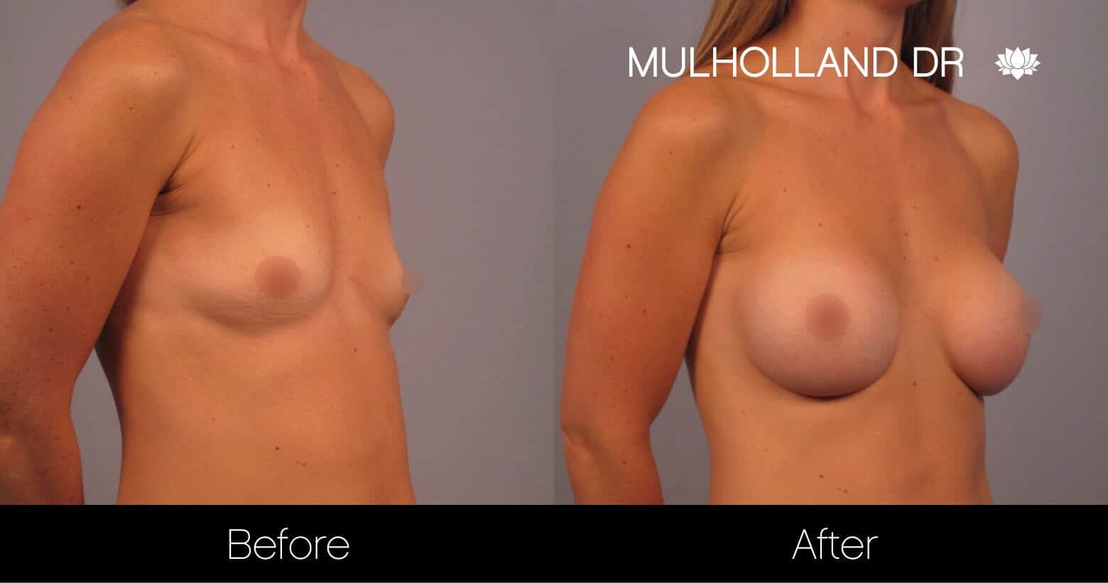 Breast Augmentation - Before and After Gallery - Patient Photo 15