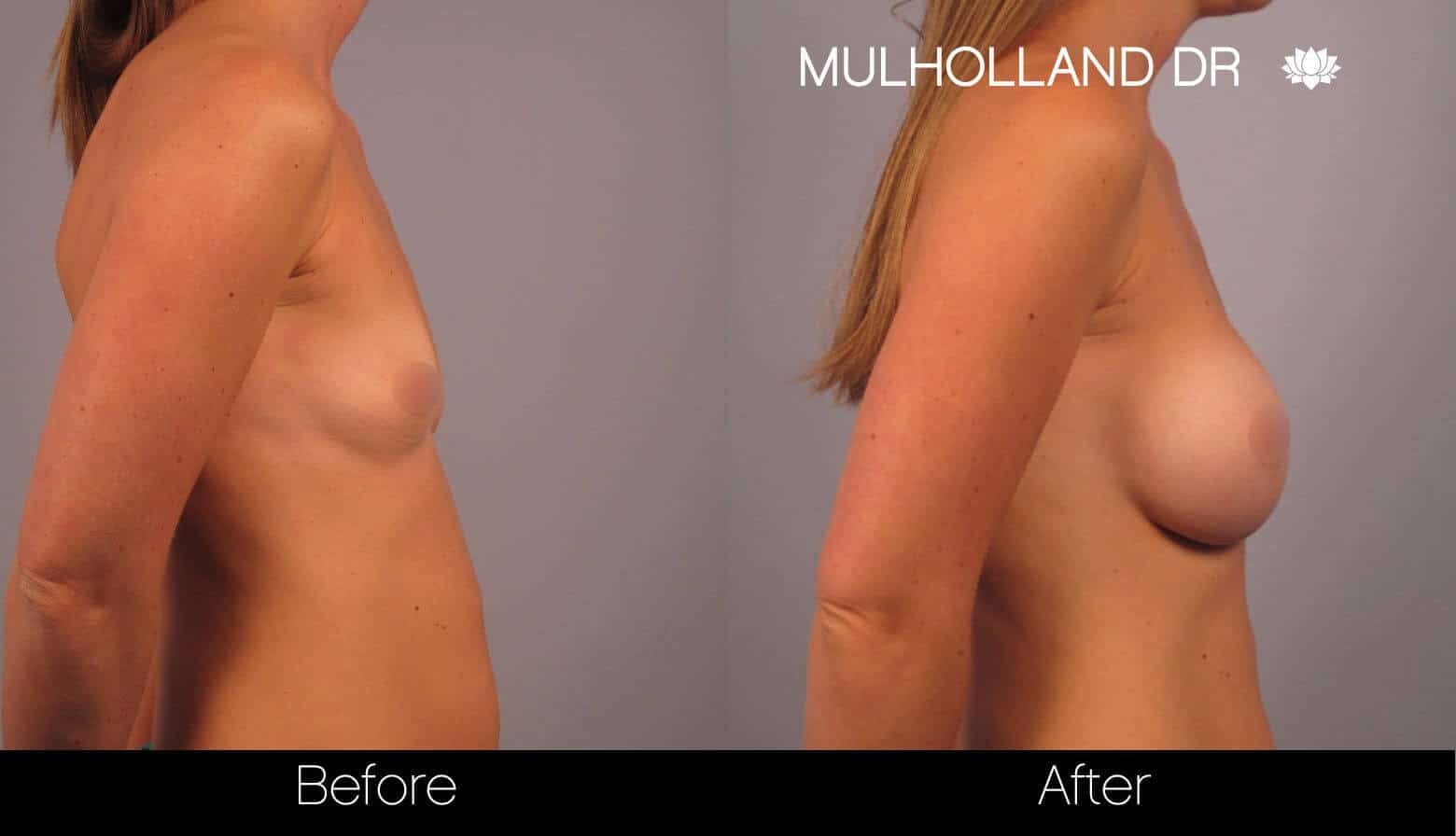 Breast Augmentation - Before and After Gallery - Patient Photo 16