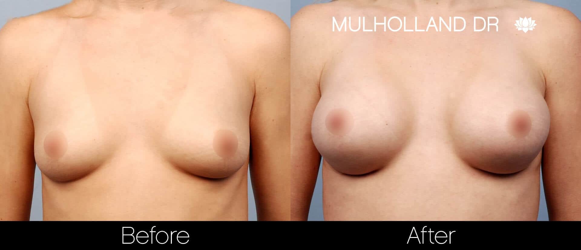 Breast Augmentation - Before and After Gallery - Patient Photo 17