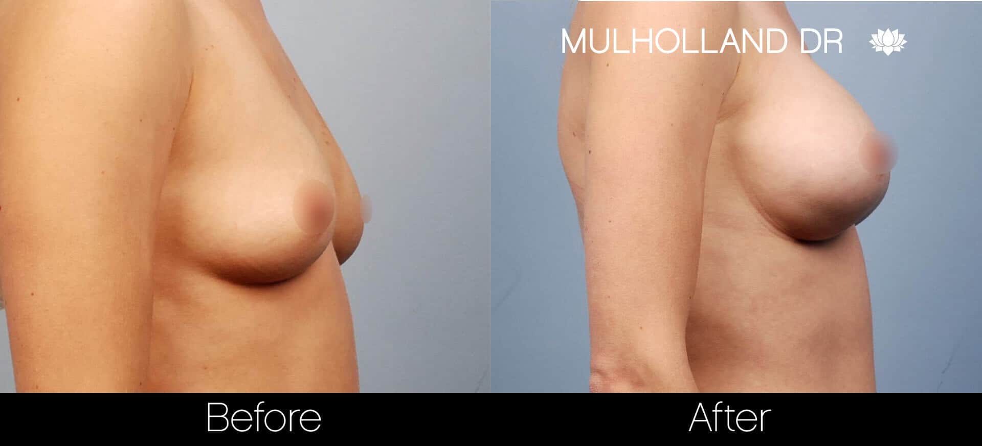 Breast Augmentation - Before and After Gallery - Patient Photo 18
